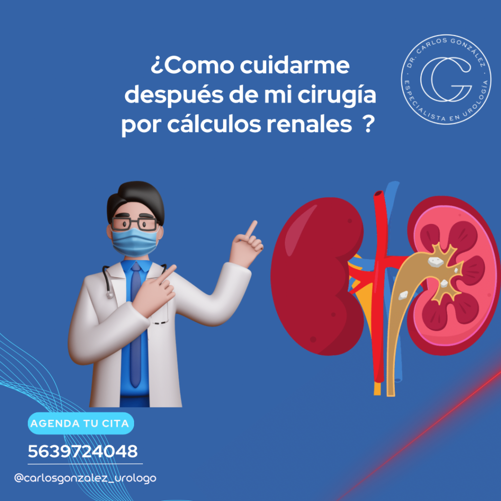 Como cuidarme despues de la cirugía por litiasis renal. Urólogo CDMX