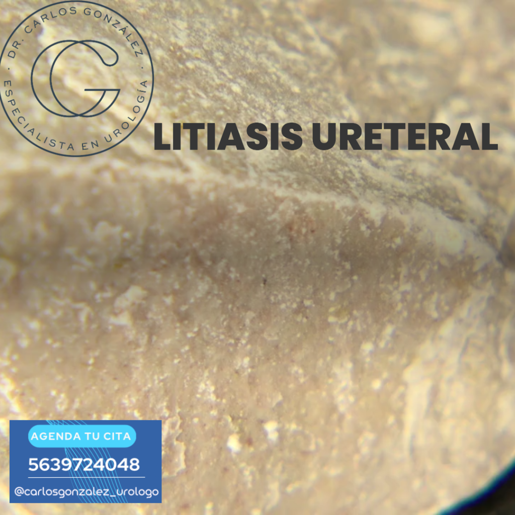 Urólogo CDMX
Litiasis ureteral