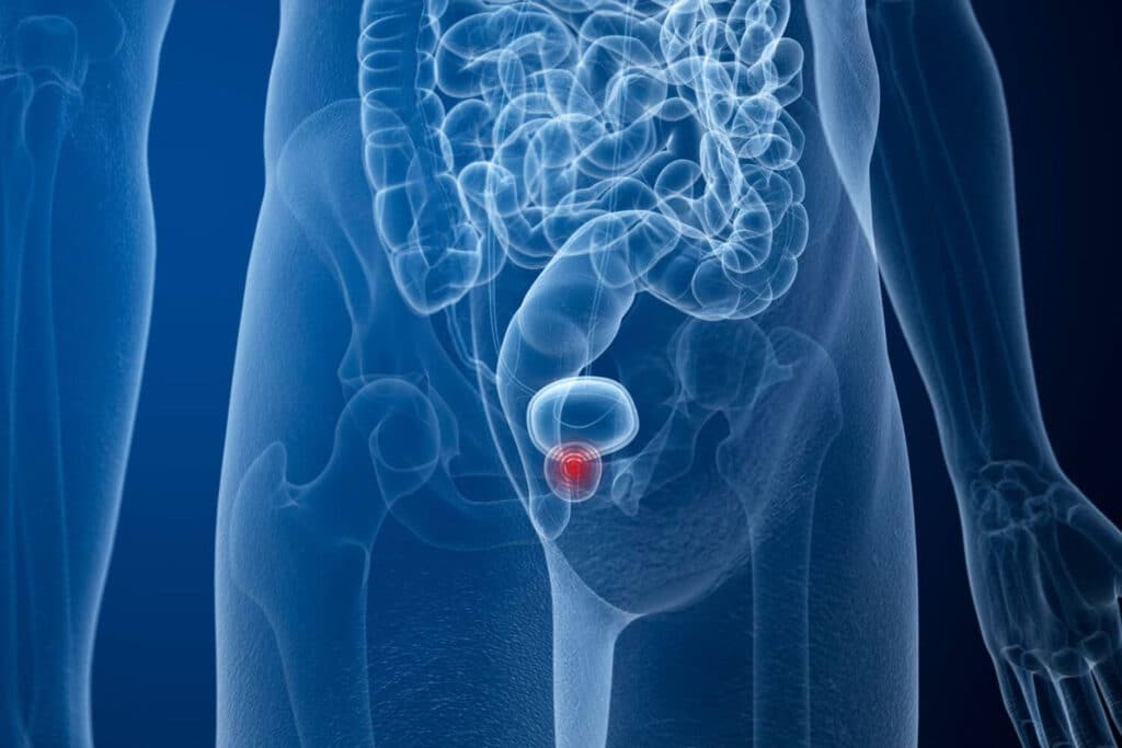 Imagen destacada Prostatectomía radical la mejor opción para el cáncer de próstata