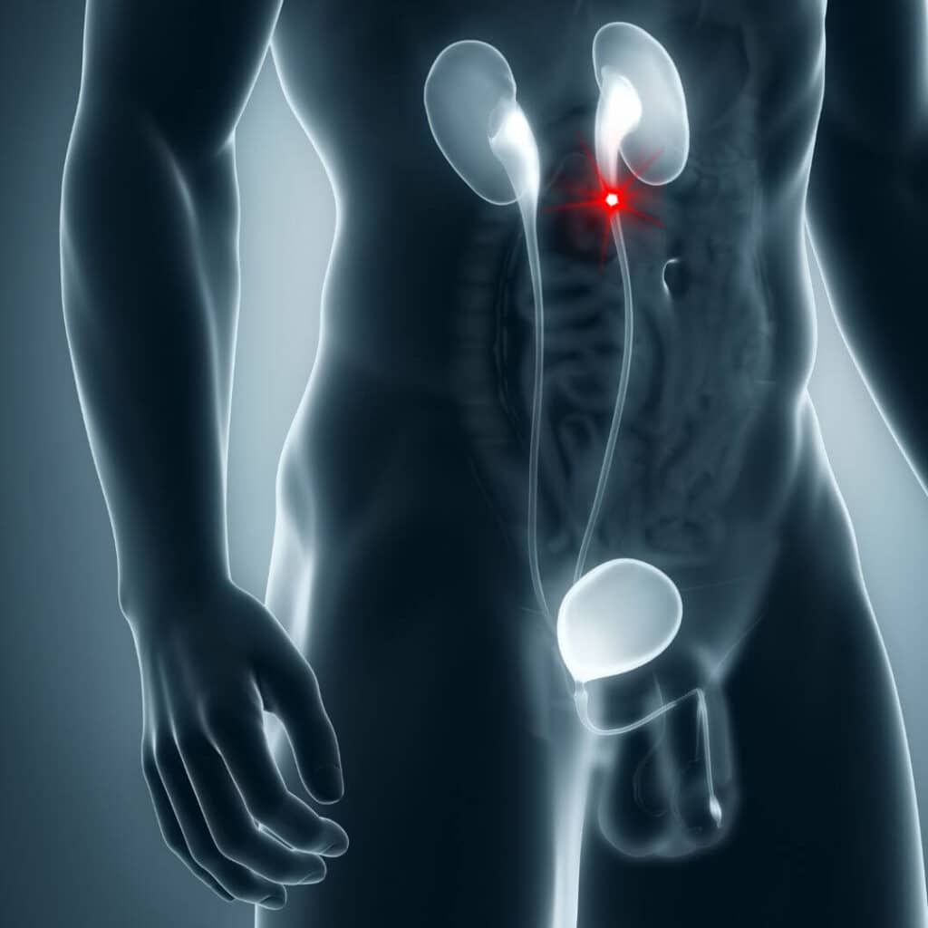 Estenosis ureteropiélica en CDMX