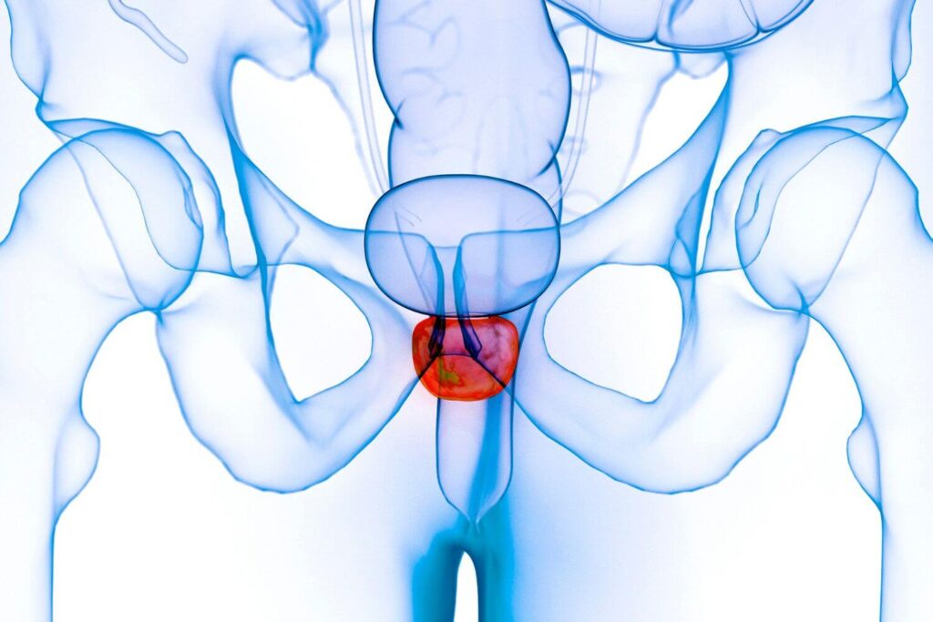 Biopsia cáncer de próstata CDMX