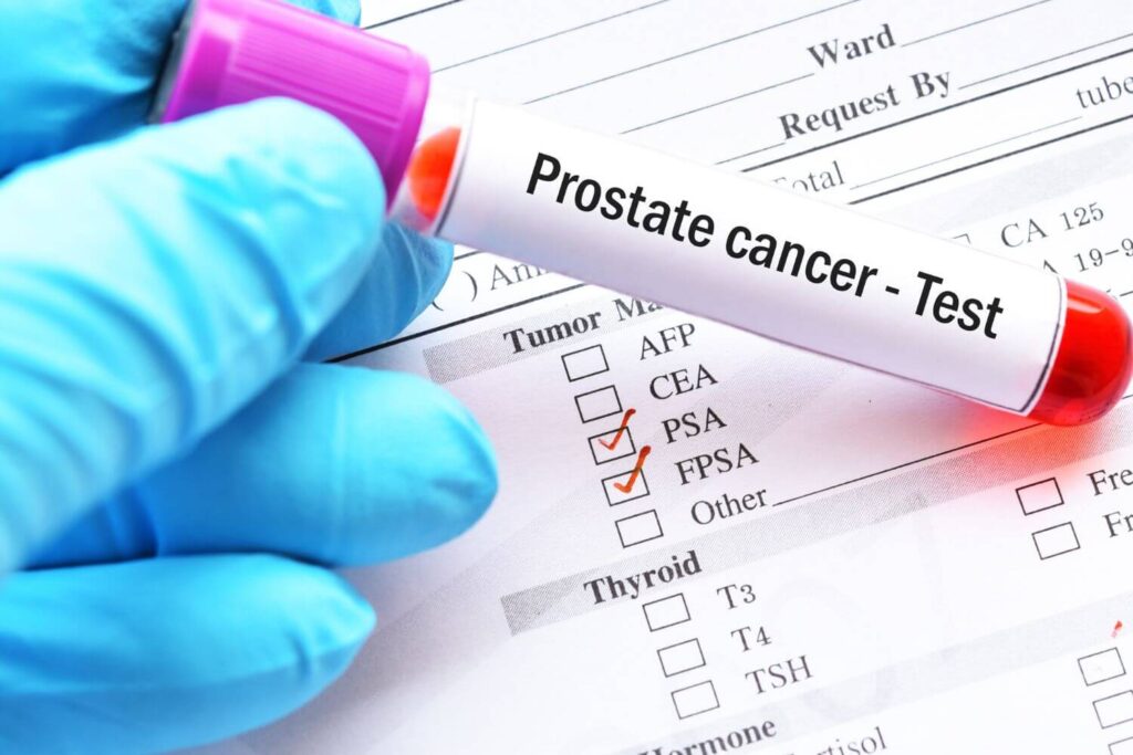 Examen PSA cáncer de próstata CDMX