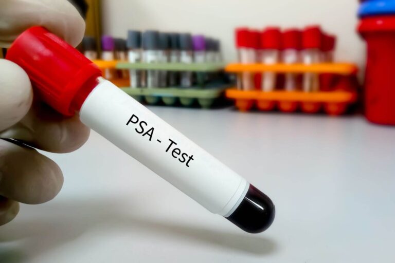 Métodos diagnósticos del cáncer de próstata PSA y otras pruebas que debes conocer