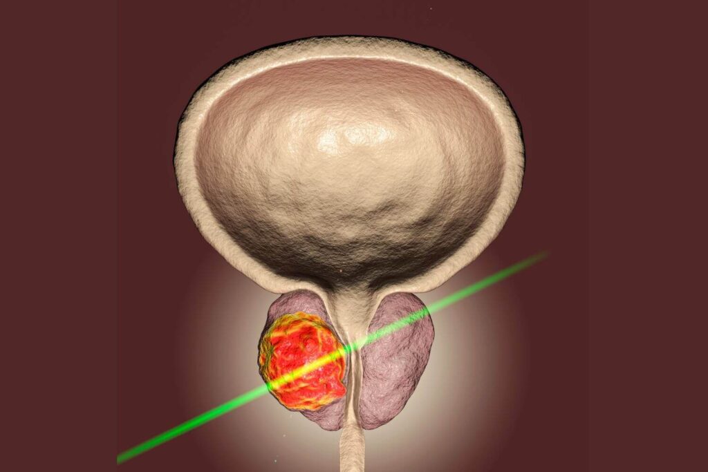 Tratamiento de vanguardia cáncer de próstata en CDMX