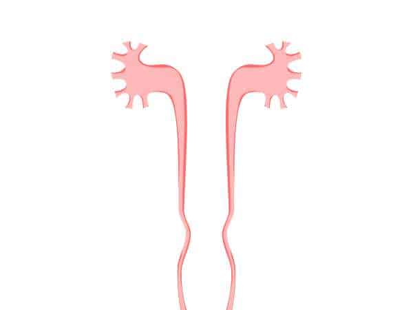 Estenosis ureteropiélica con cirugía robótica Da Vinci en CDMX